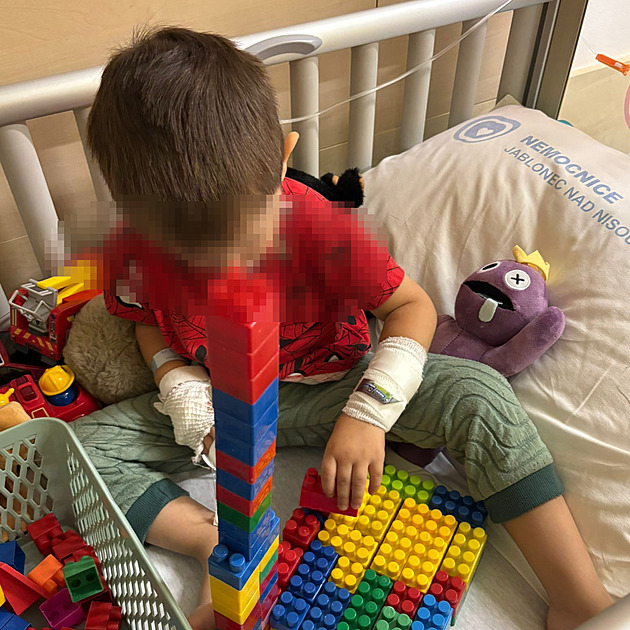 Nešťastná náhoda. Otec vnáší jasno do případu popáleného dítěte ve školce